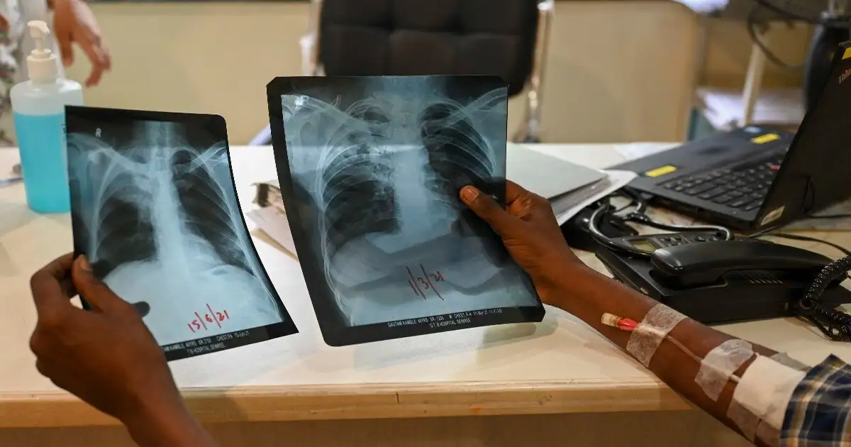 india tb malaria cases decline health success ભારતમાં TB અને મલેરિયા સામે મોટી જીત